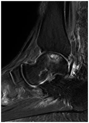 Analysis of preoperative and postoperative depression and anxiety in patients with osteochondral lesions of the talus
